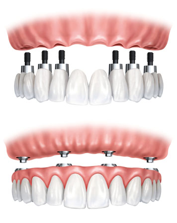 Implant-Supported Full and Partial Dentures